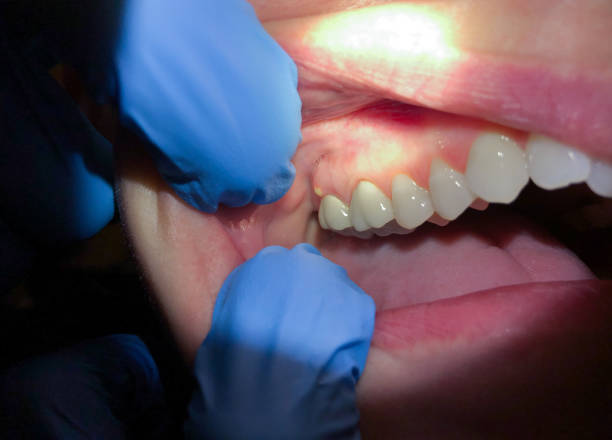 Best Emergency Dental Care for Broken or Chipped Teeth in Emma, NC